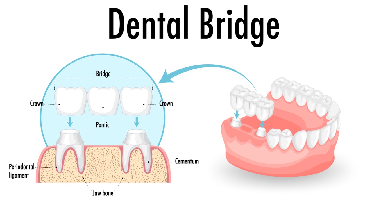 Bridges 